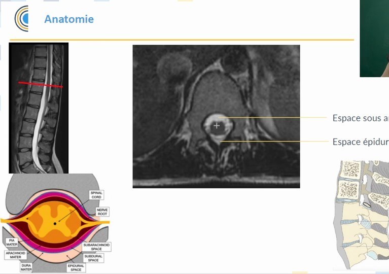 Syndrome médullaire et espacés anatomiques