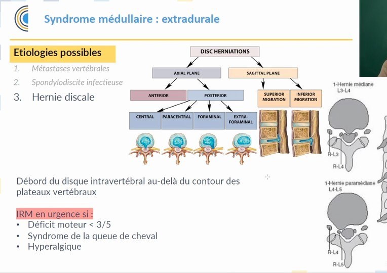 Étiologies extradurales de compression médullaire