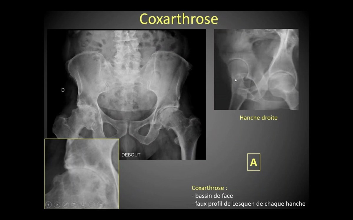 Coxarthrose sur radiographie