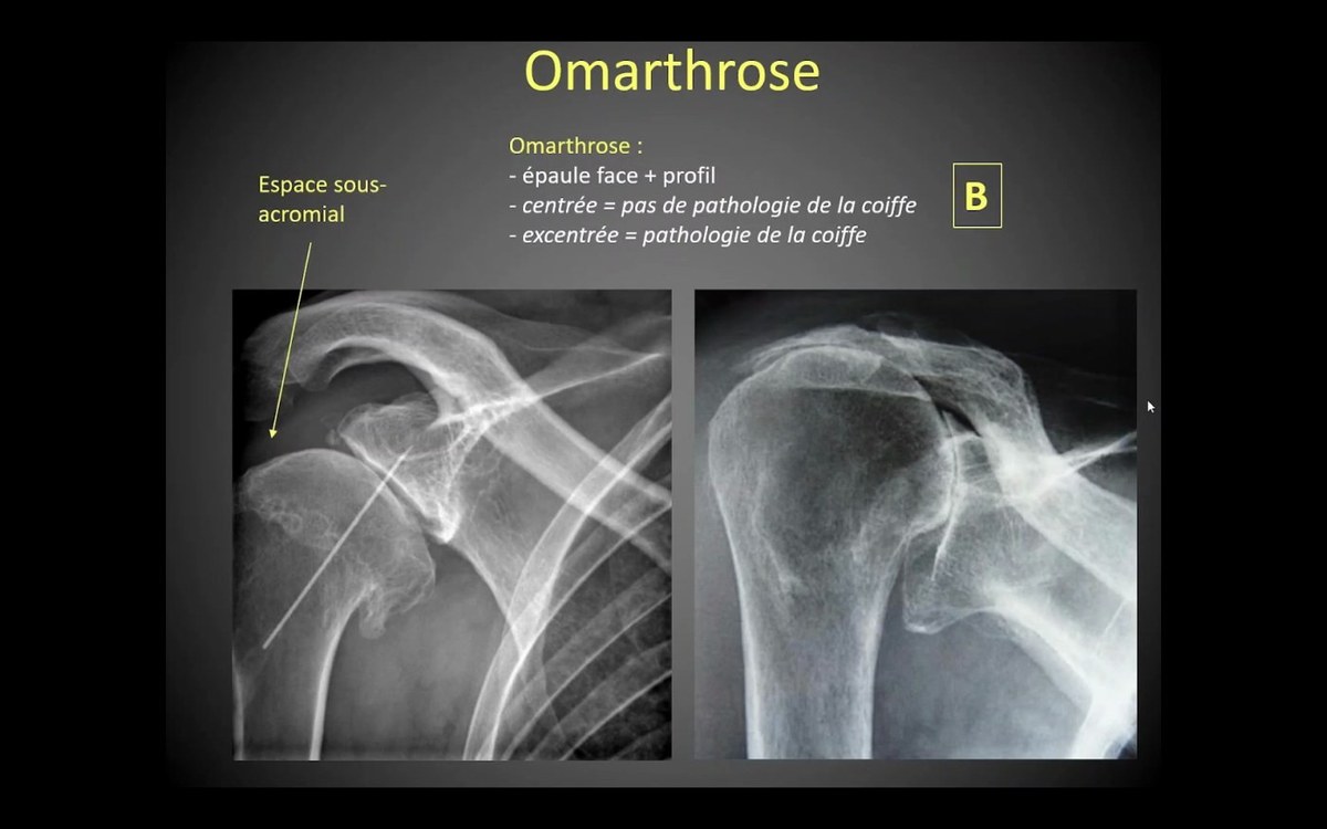 Omarthrose et épaule