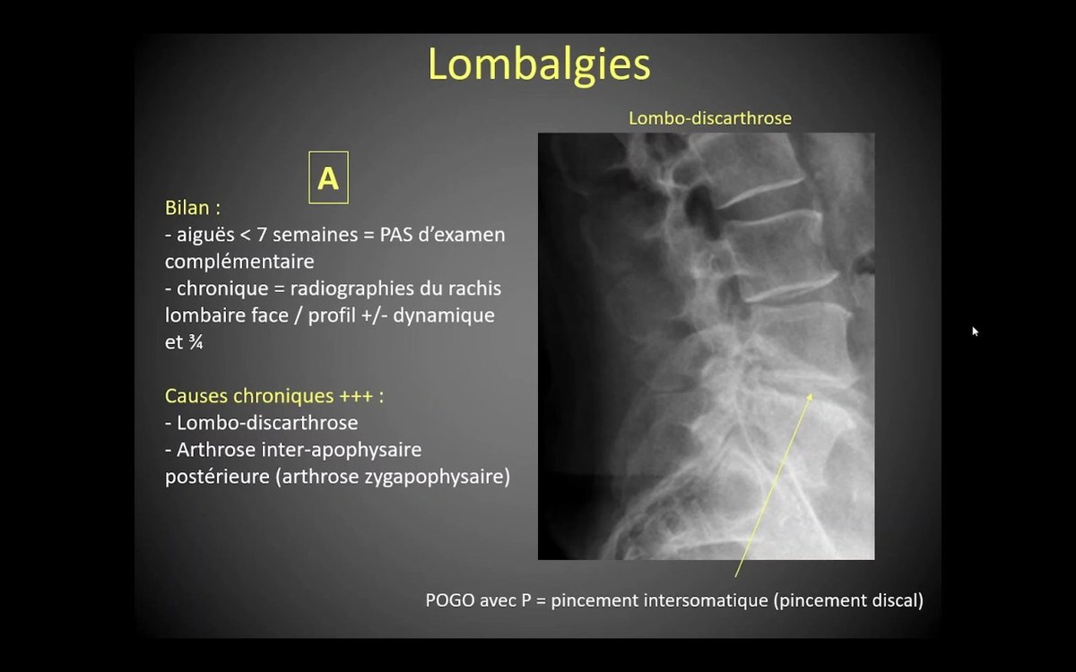 Lombalgie et signes radiologiques