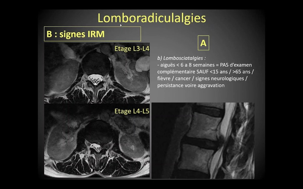 Lomboradiculalgie en IRM