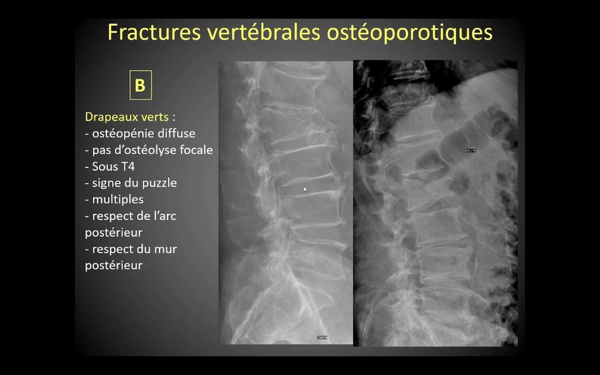 Fractures vertebrales osteoporotiques