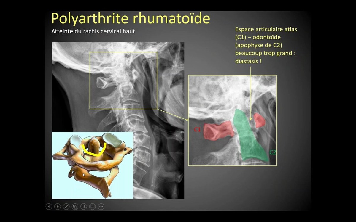 Polyarthrite rhumatoïde en imagerie