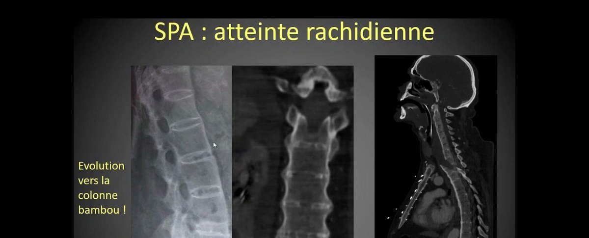 Spondyloarthrite rachidienne