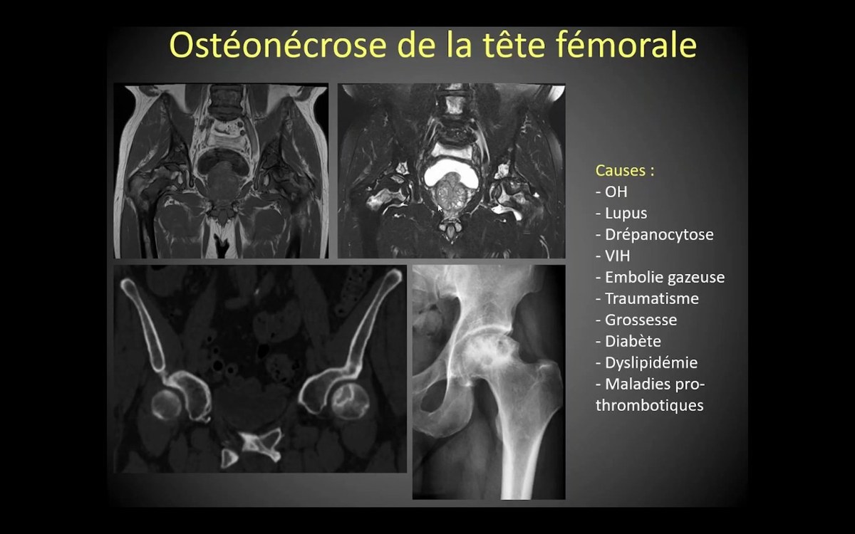 Osteonecrose de la tête fémorale