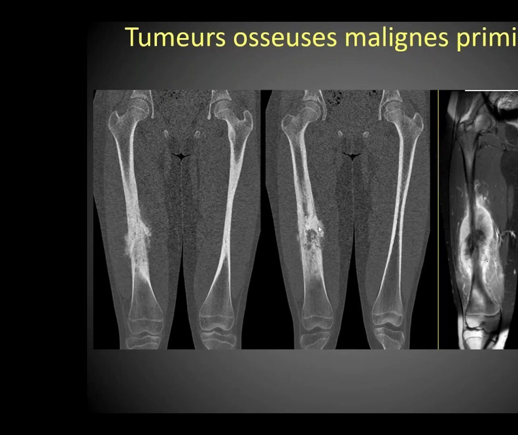 Tumeurs osseuses malignes primitives