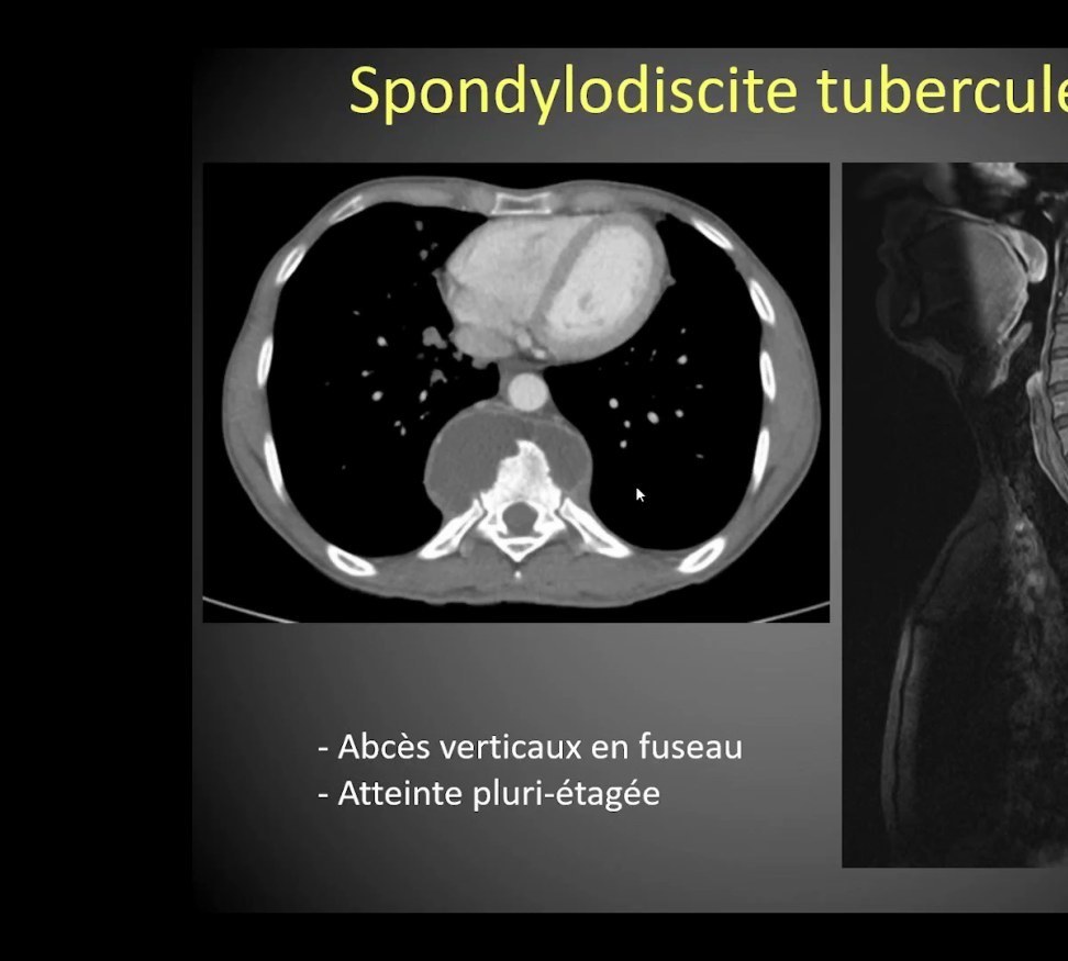 Spondylodiscite tuberculeuse