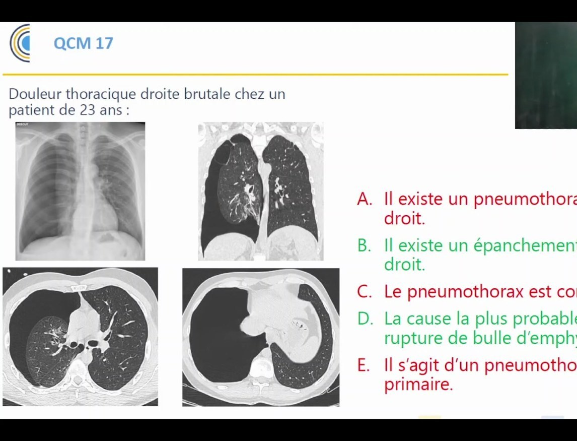 Opacités pulmonaires diffuses