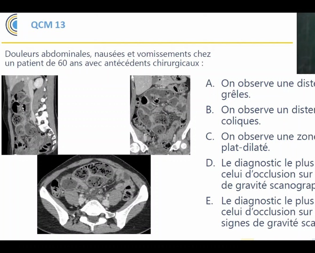 QCM scanner d'abdomen aigu