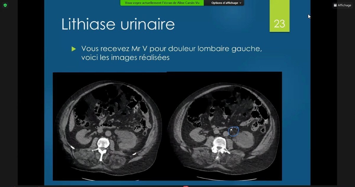 Lithiase urinaire au scanner