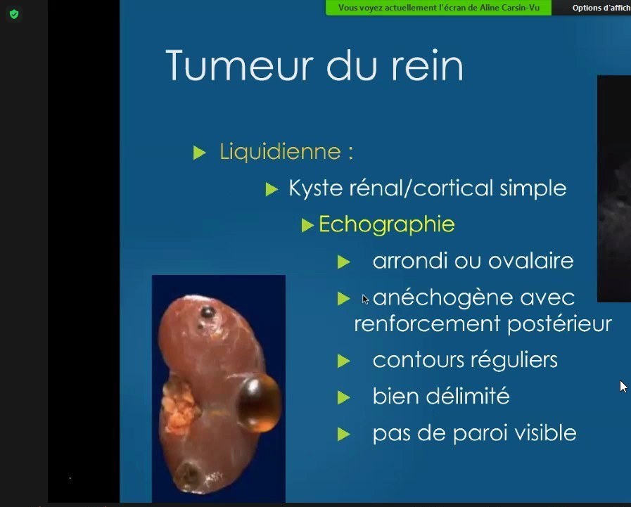Tumeur du rein et caractérisation