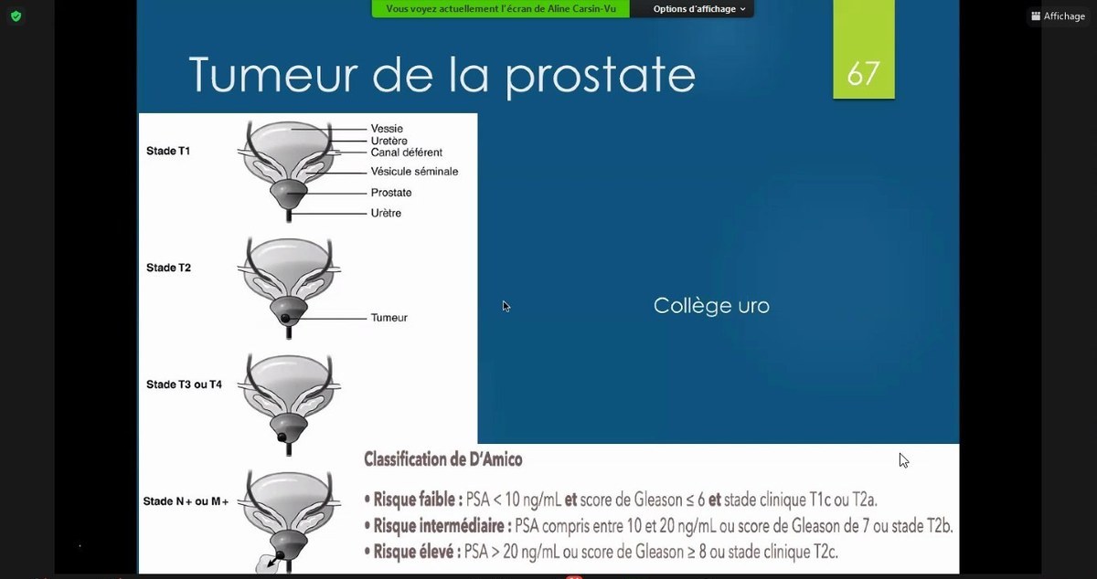 IRM prostate et schéma zonal