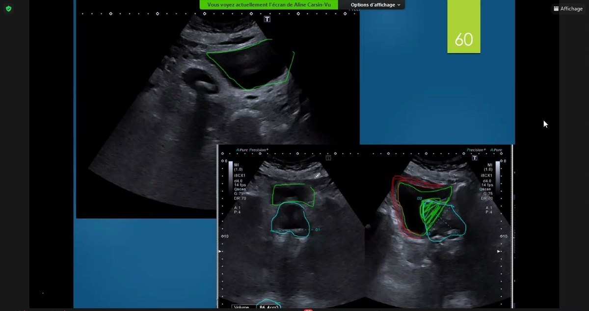 Pathologie genitoscrotale en échographie