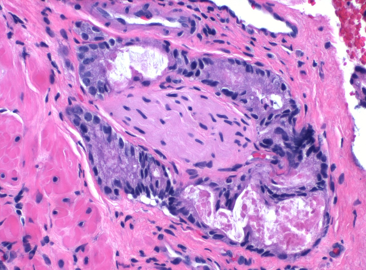 Adénocarcinome prostatique Gleason 3+3 avec PIN associée