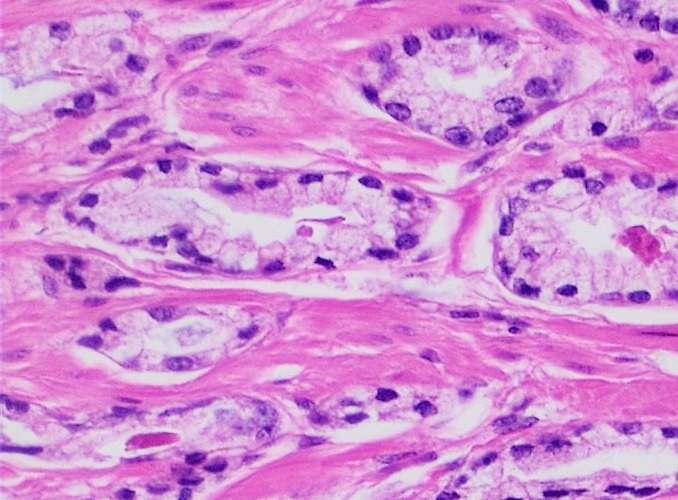 Adénocarcinome acinaire — comparaison avec PIN