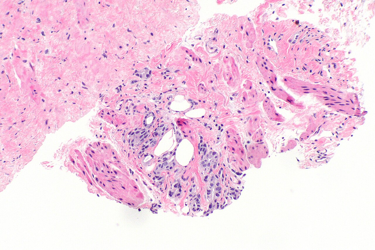 Extension extraprostatique du cancer de la prostate