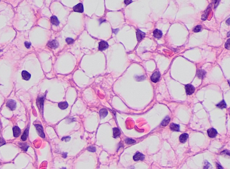 Carcinome à cellules claires du rein — grade 1 ISUP