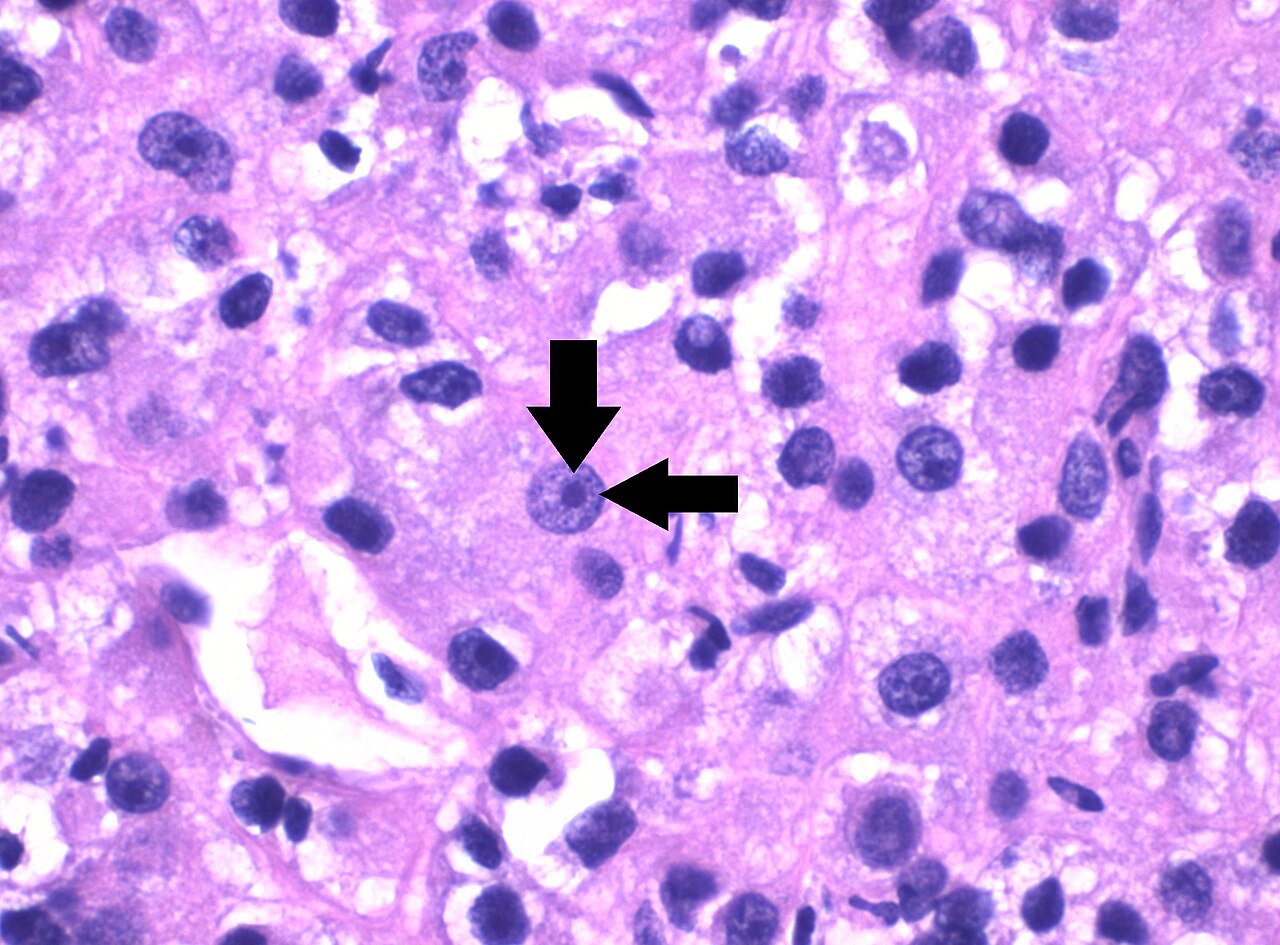 Carcinome à cellules claires — grade 3 ISUP