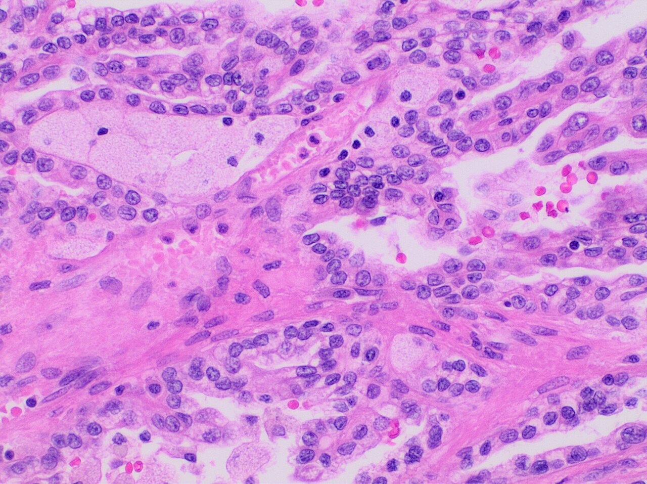 Carcinome papillaire du rein — type 1