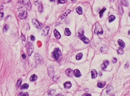 Carcinome à cellules claires (ccRCC) — histologie conventionnelle
