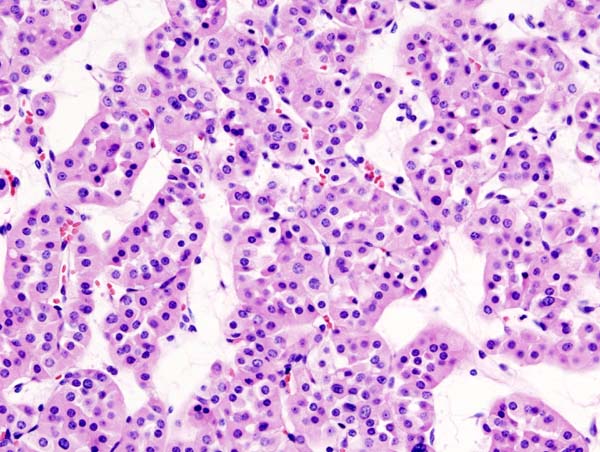 Oncocytome rénal — pièce de néphrectomie