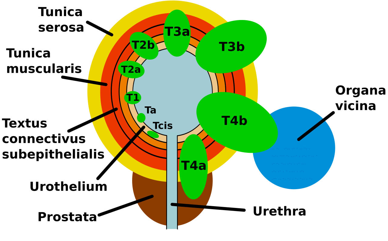 Classification TNM du cancer de la vessie