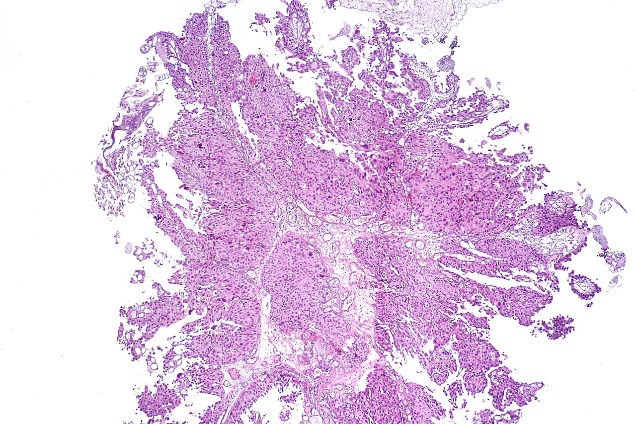 Carcinome urothélial papillaire non invasif de haut grade