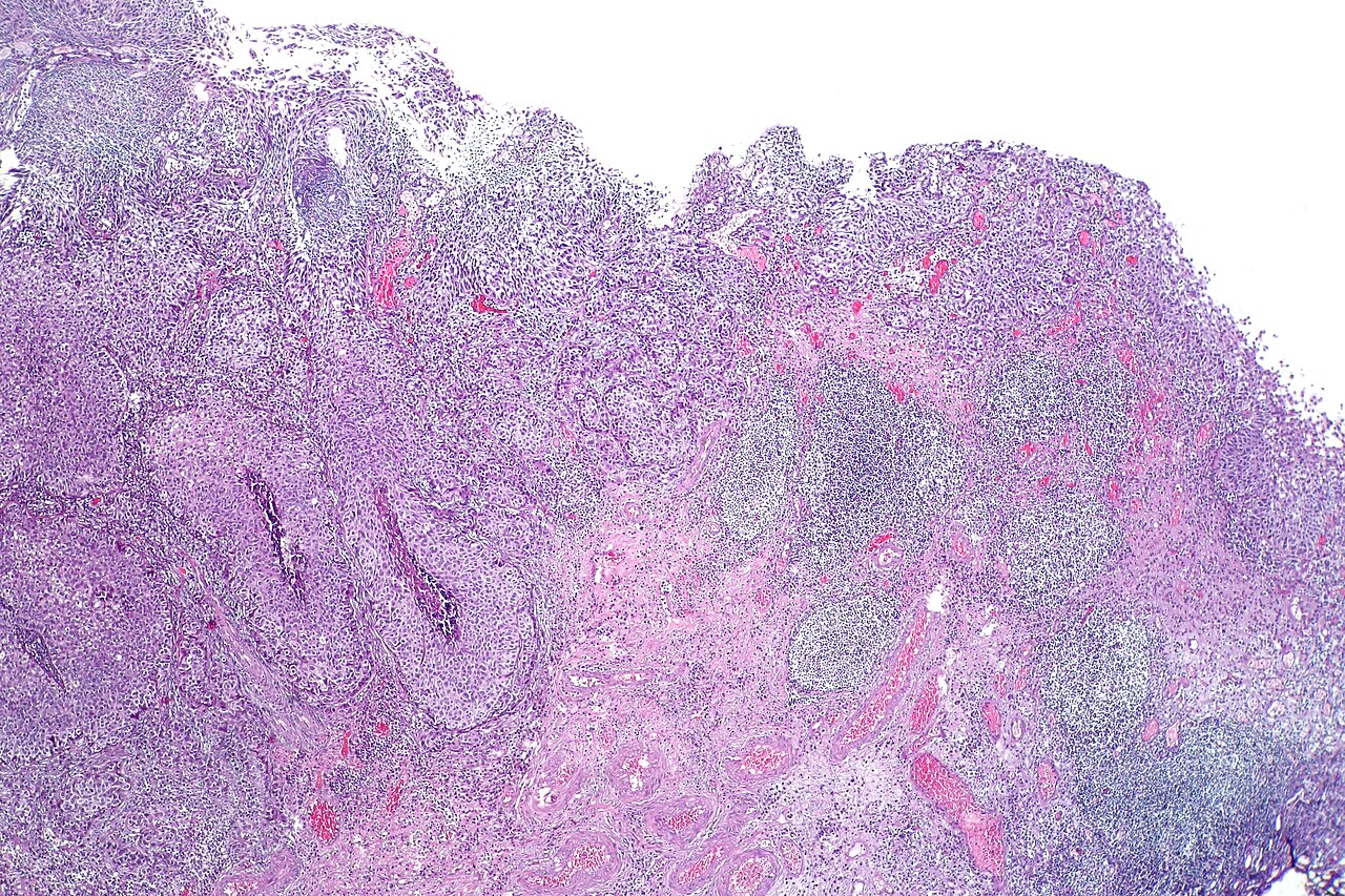Carcinome urothélial pT1 avec réaction stromale