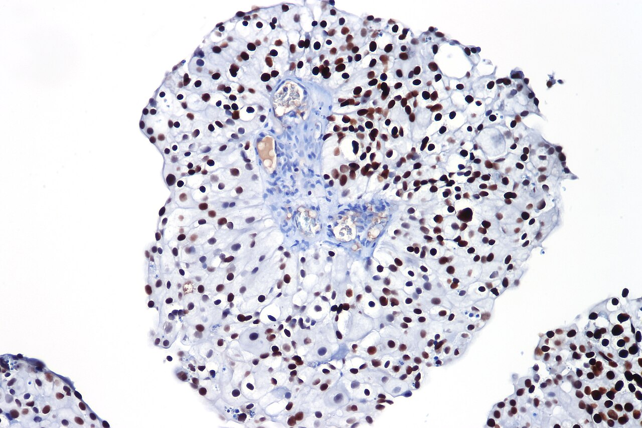 GATA3 positif dans le carcinome urothélial