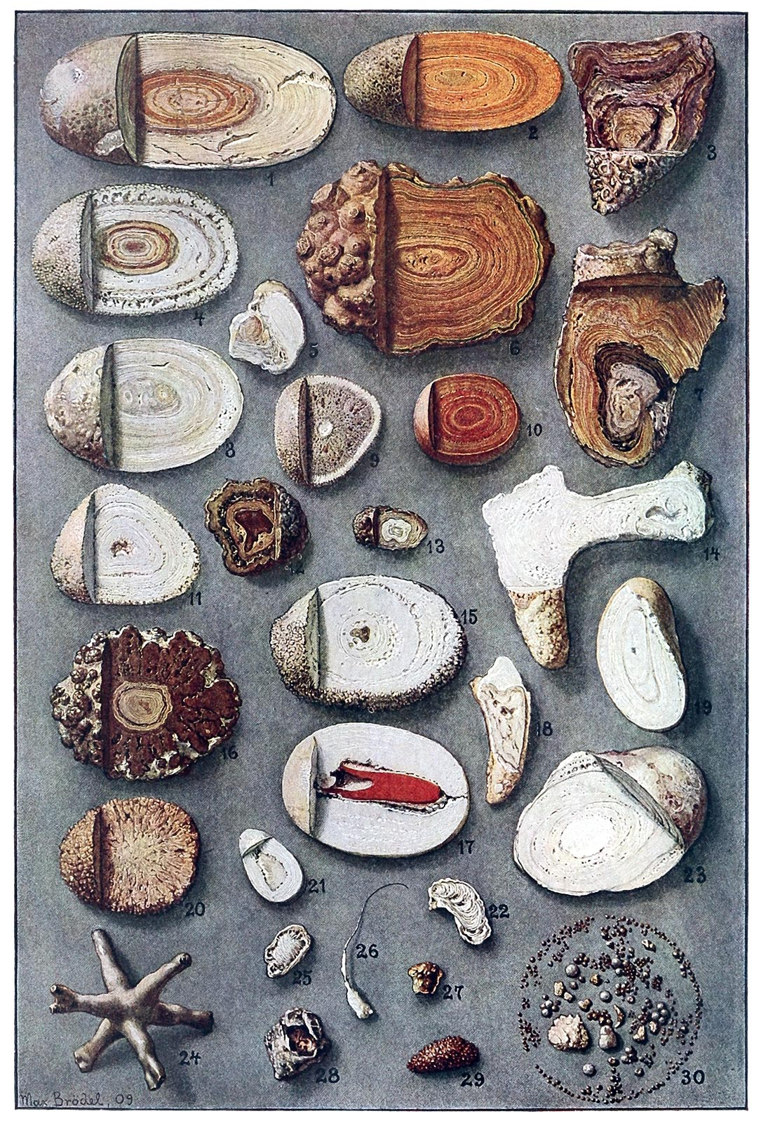 Collection de calculs rénaux et vésicaux