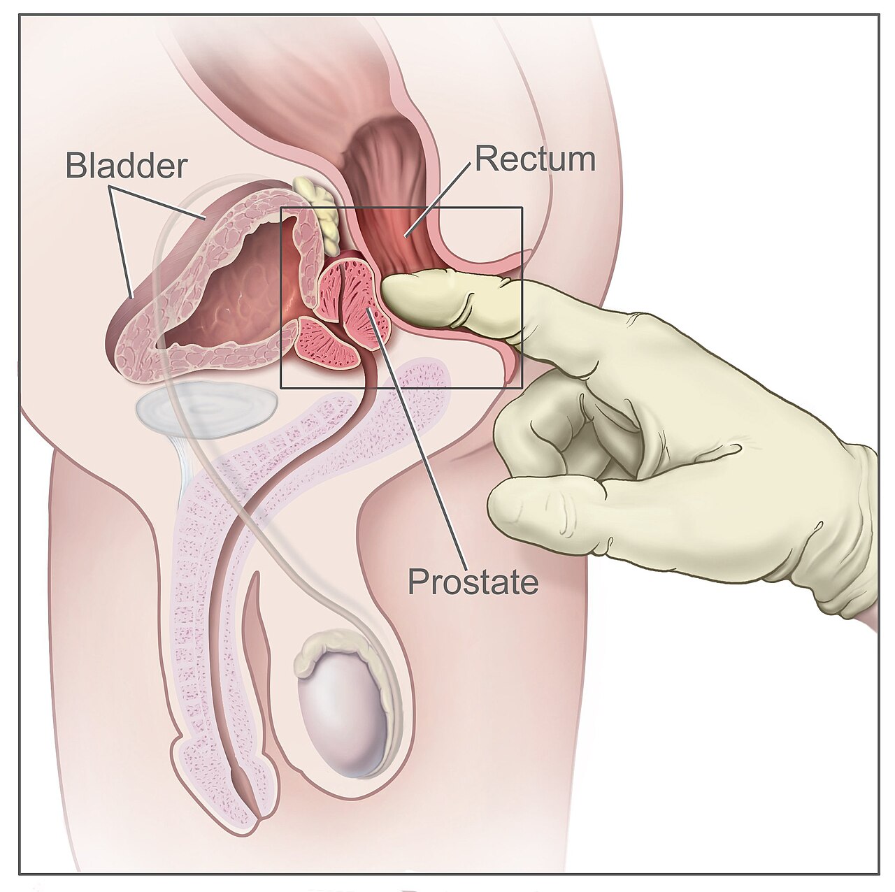 Toucher rectal précédant le recueil urinaire