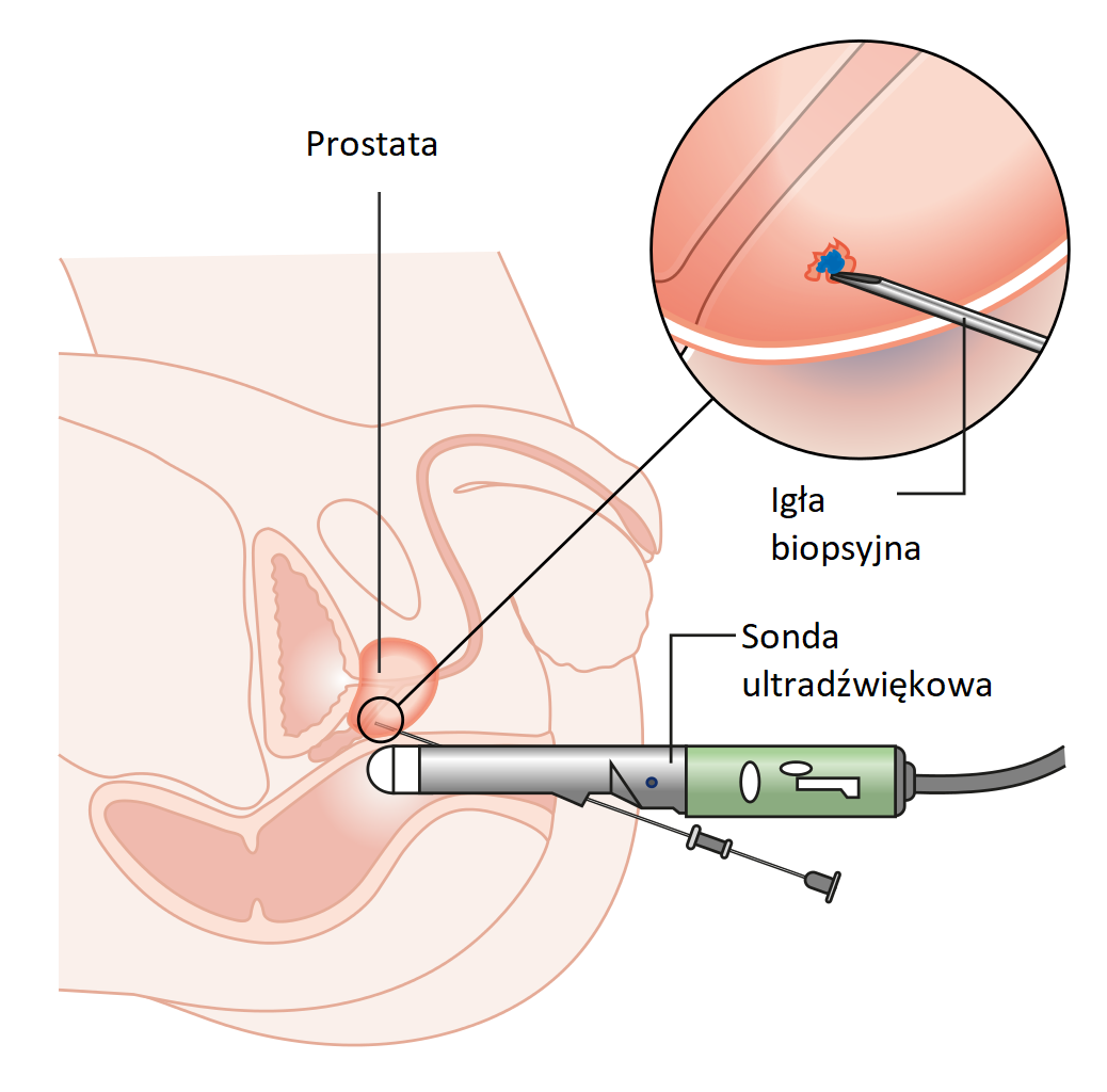 Biopsie prostatique guidée