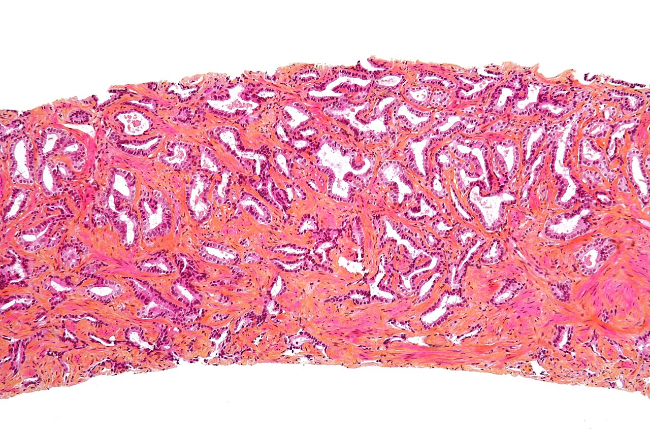 Biopsie prostatique — adénocarcinome