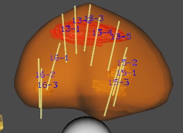 Biopsie par fusion IRM-échographie