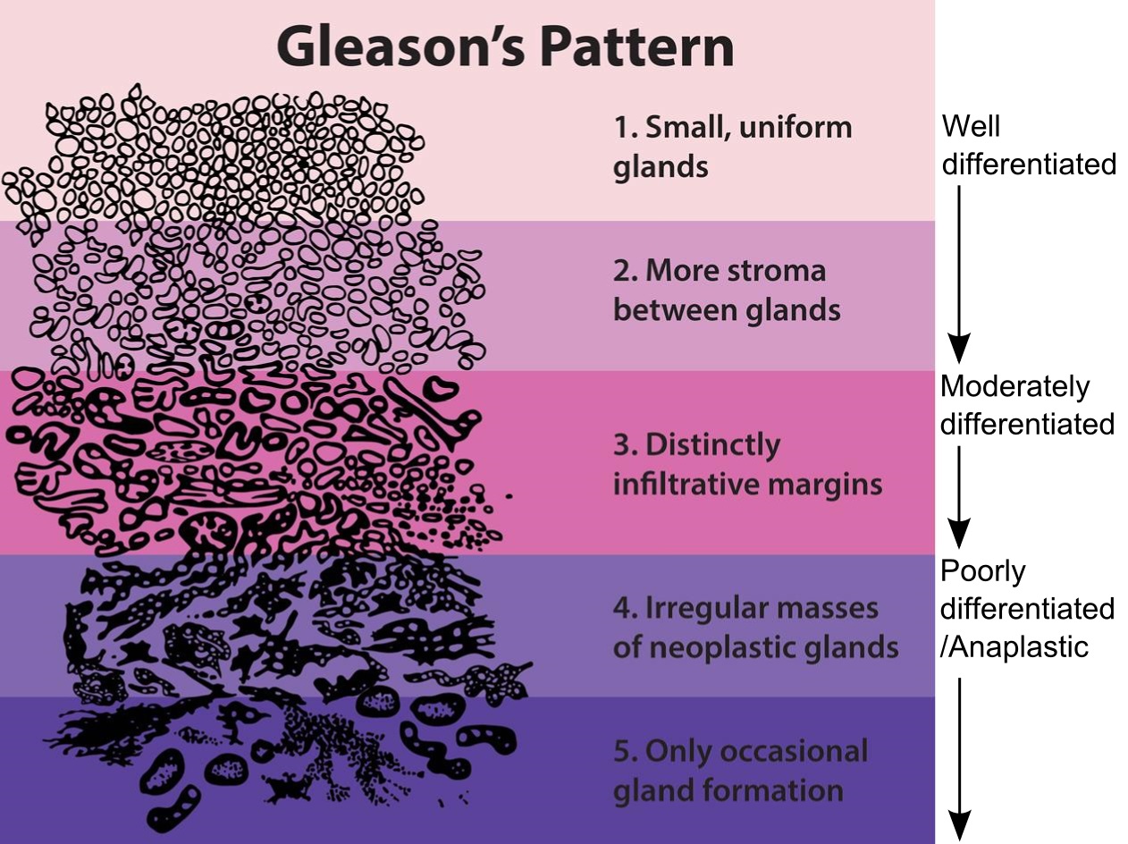 Grades histologiques de Gleason