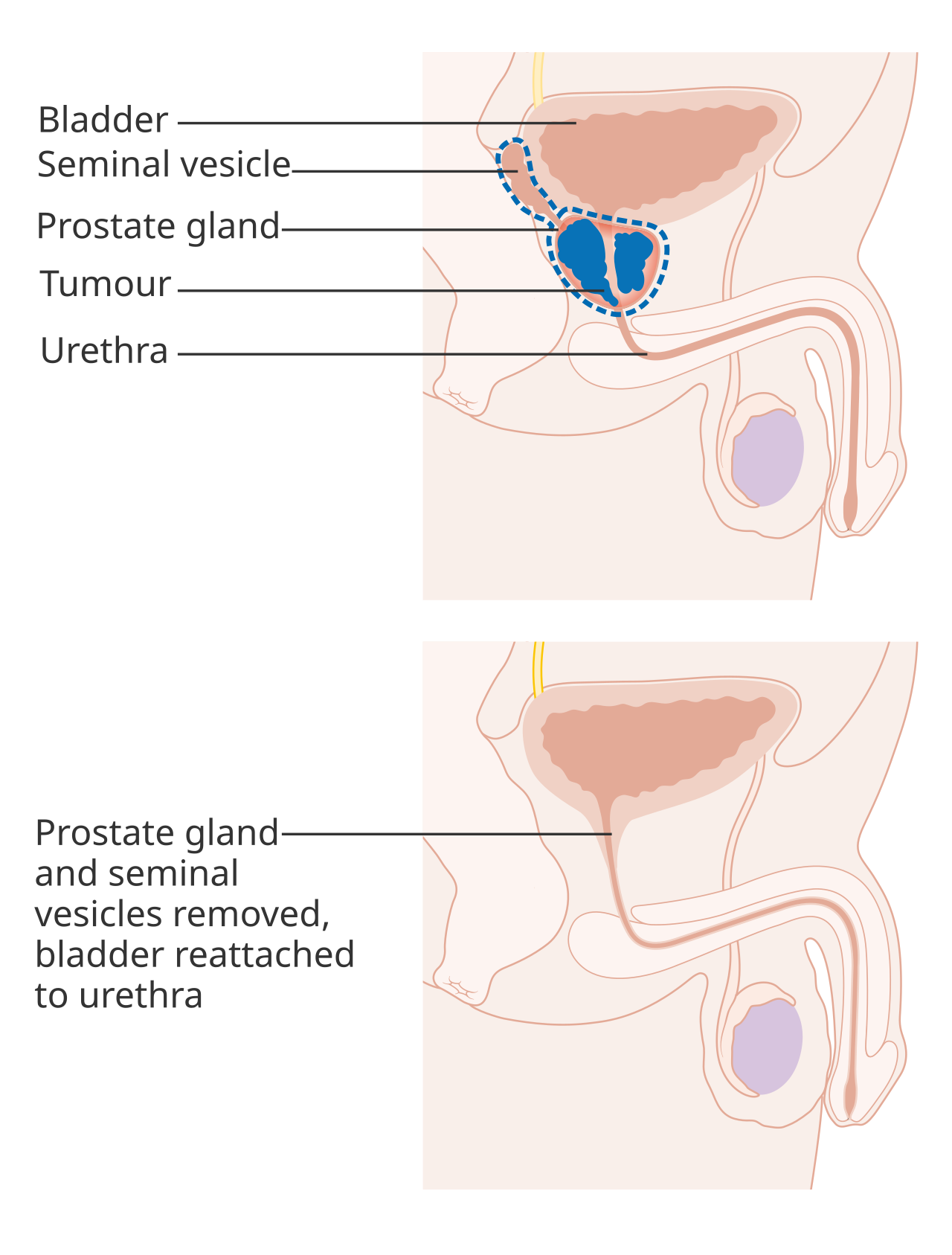 Prostatectomie totale