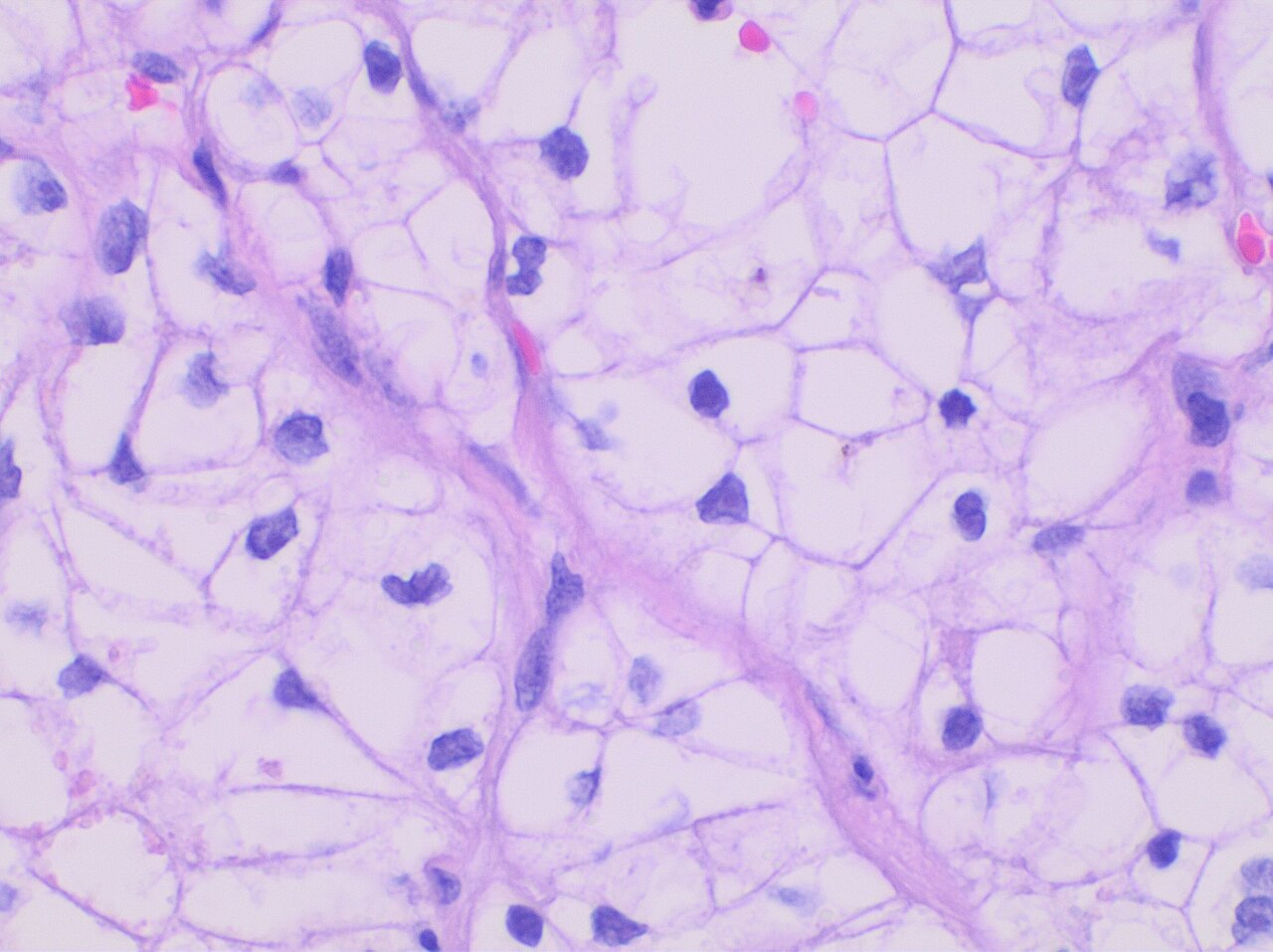 Carcinome rénal à cellules claires grade 2