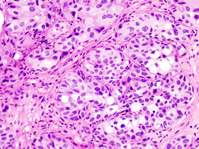 Histopathologie du carcinome urothélial