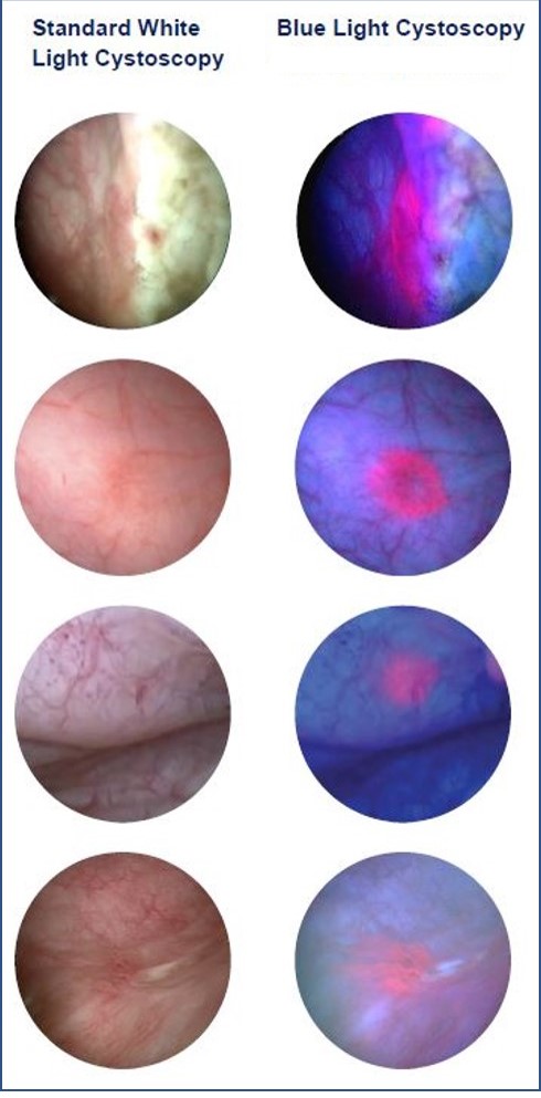 Cystoscopie en lumière bleue (fluorescence)