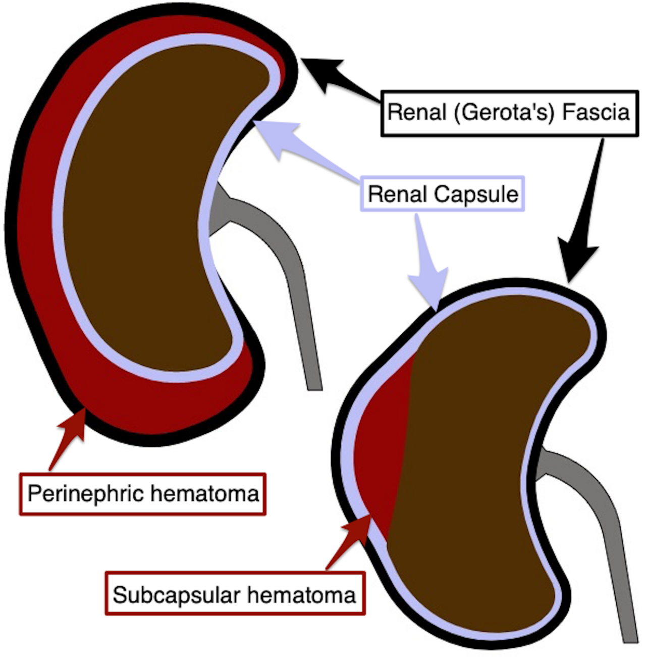 Hématomes rénaux — classification