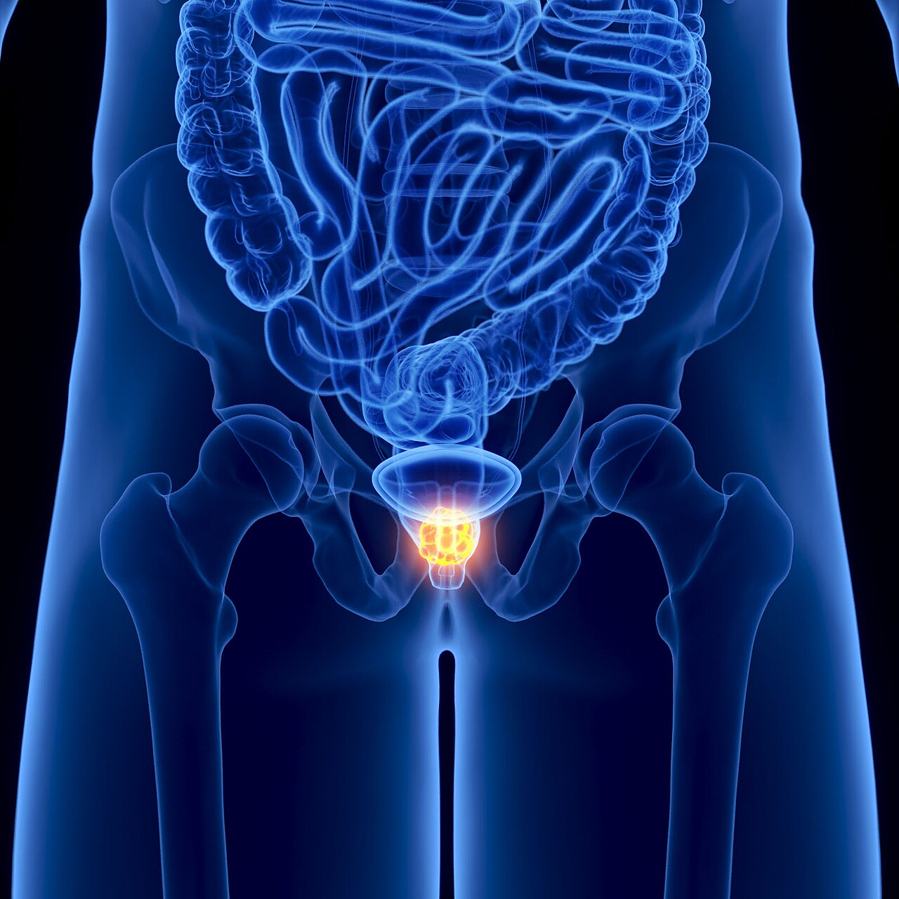 Métastases osseuses osteocondensantes
