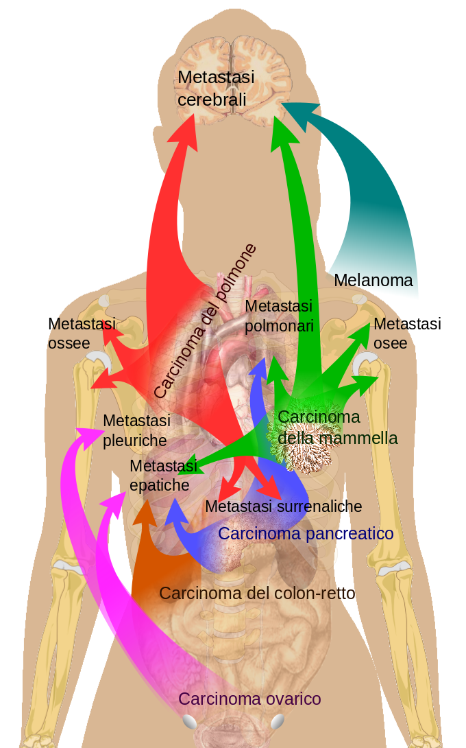 Sites métastatiques du cancer de prostate