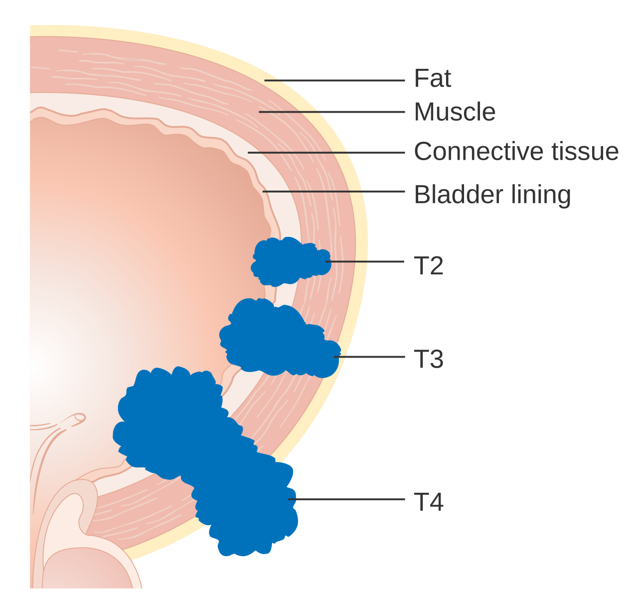 Cancer de vessie infiltrant le muscle (TVIM)
