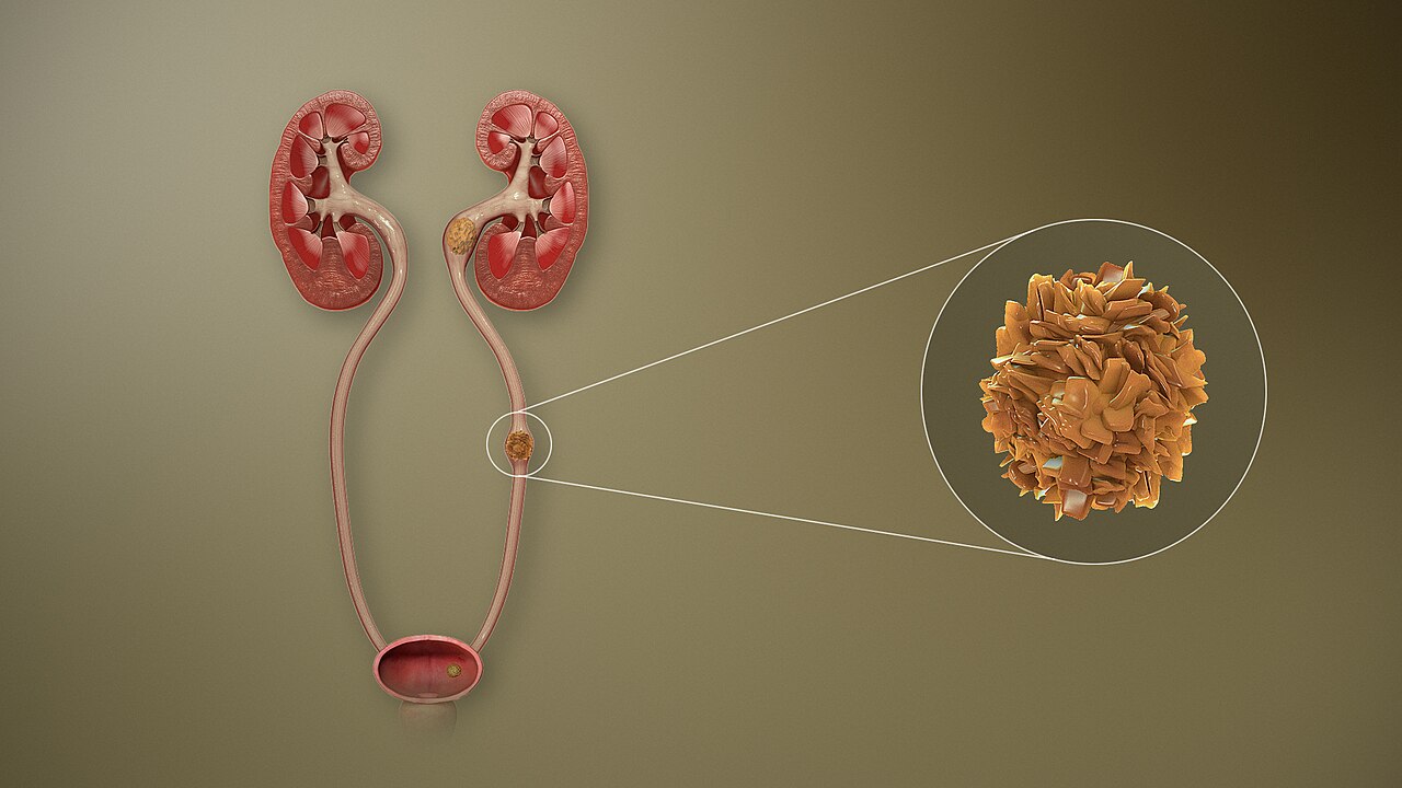 Calcul urétéral — schéma 3D