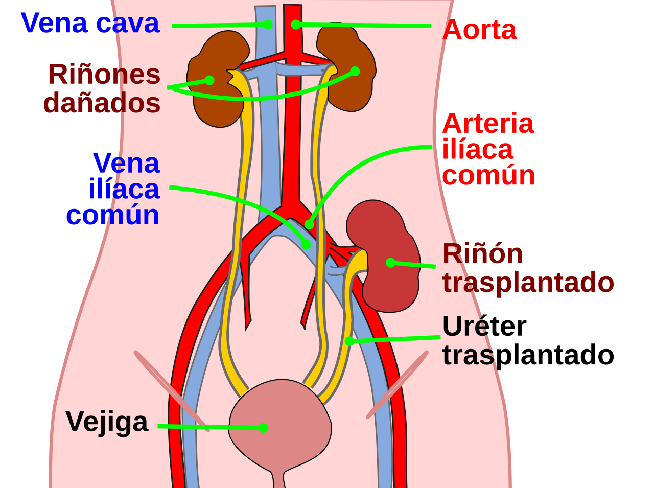 Schéma descriptif de la transplantation rénale