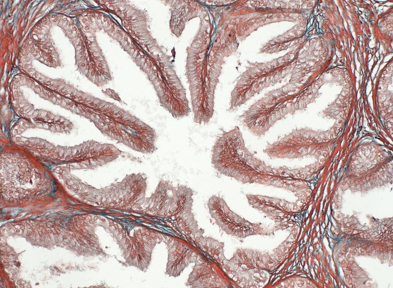 Adénocarcinome prostatique