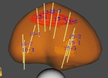 Système de fusion écho-IRM