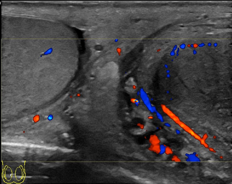 Doppler testiculaire