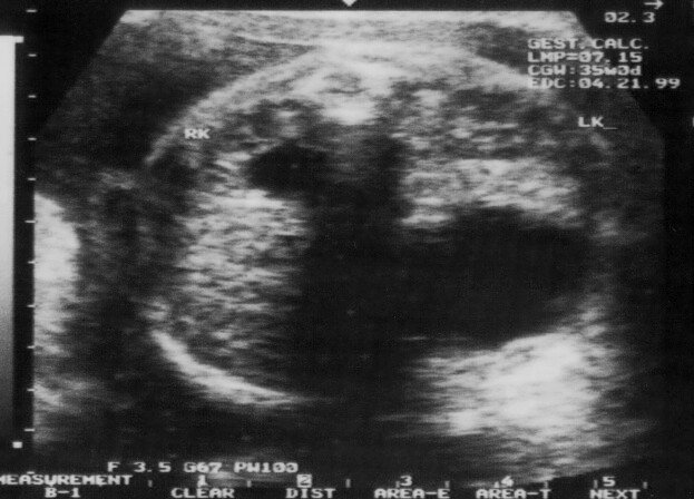 Dilatation rénale physiologique de grossesse